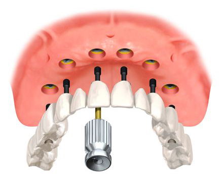 3D Implantologie: Implantate Oberkiefer