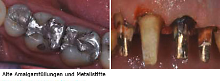 amalgam und metall