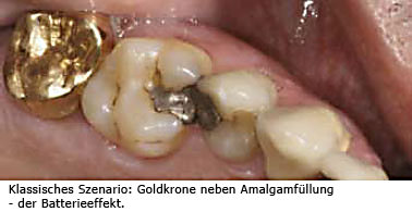 Goldkrone und Amalgam
