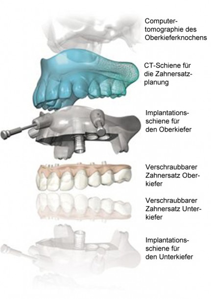 Kaskade 3D Implantologie Kaskadenmodell des 3D Implantologieverfahrens