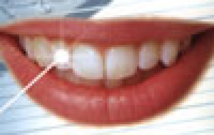 Laserbehandlung Zahnlaser