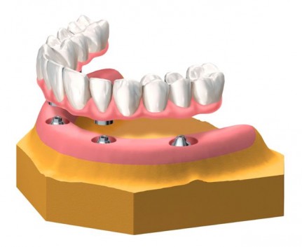 Verschraubbarer Zahnersatz am Unterkiefer