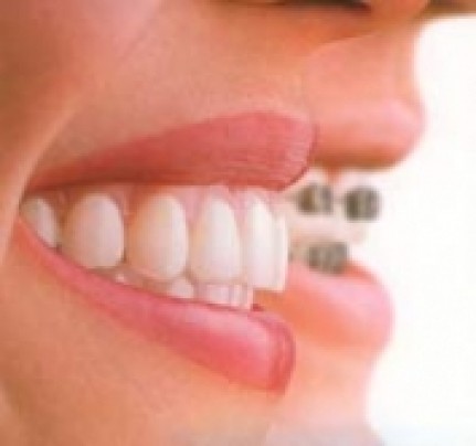 Invisalign die unsichtbare Zahnspange unsichtbare Zahnspange Invisalign